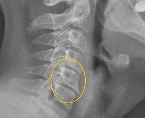 پوکی استخوان ستون فقرات گردن رحم بر روی x -ray