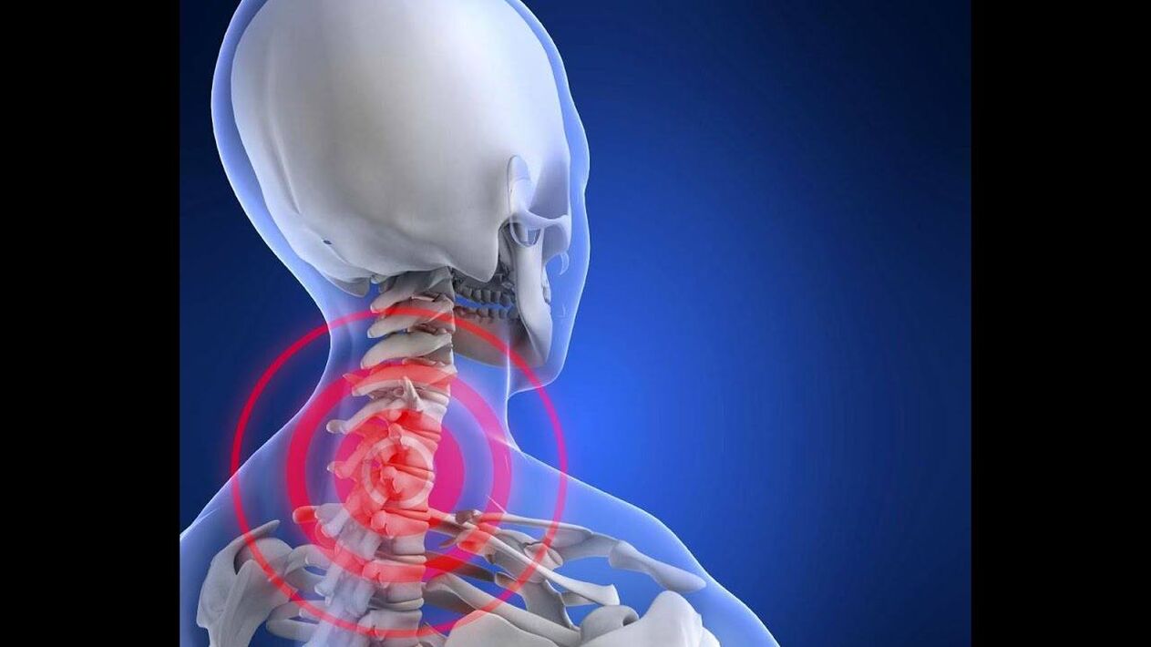 استئوکندروز ستون فقرات گردنی